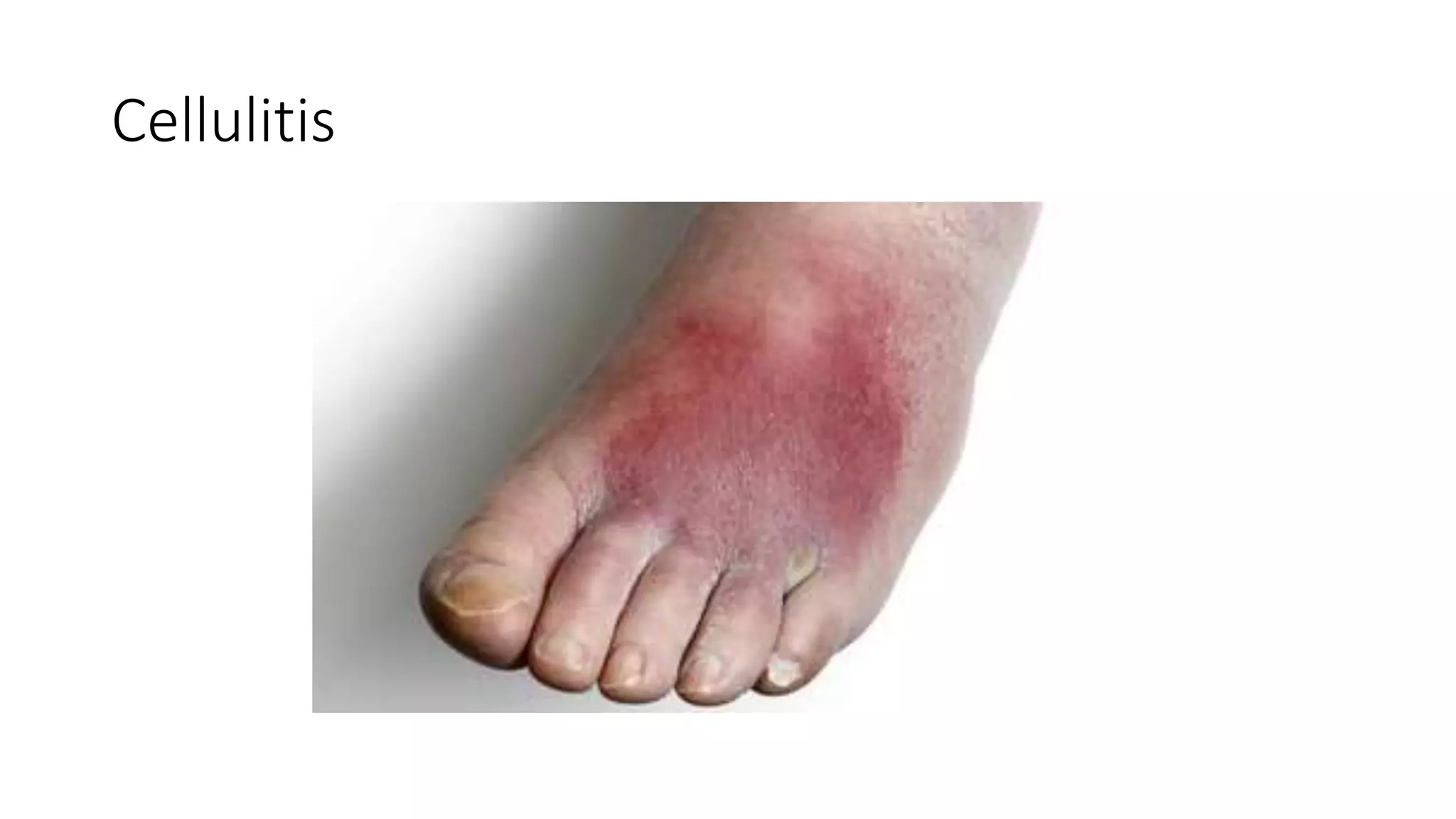 Cellulitis
 
