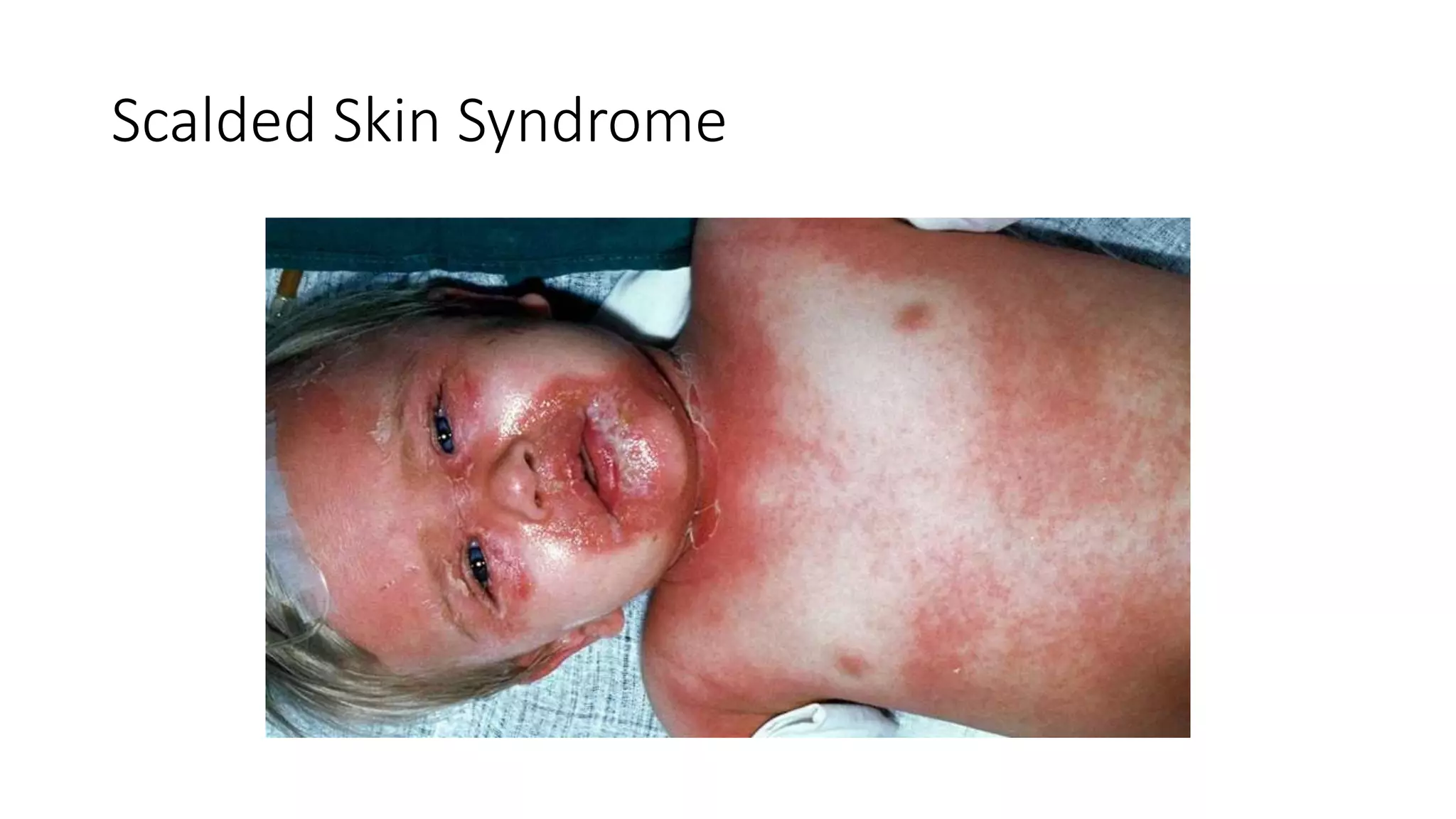 Scalded Skin Syndrome
 