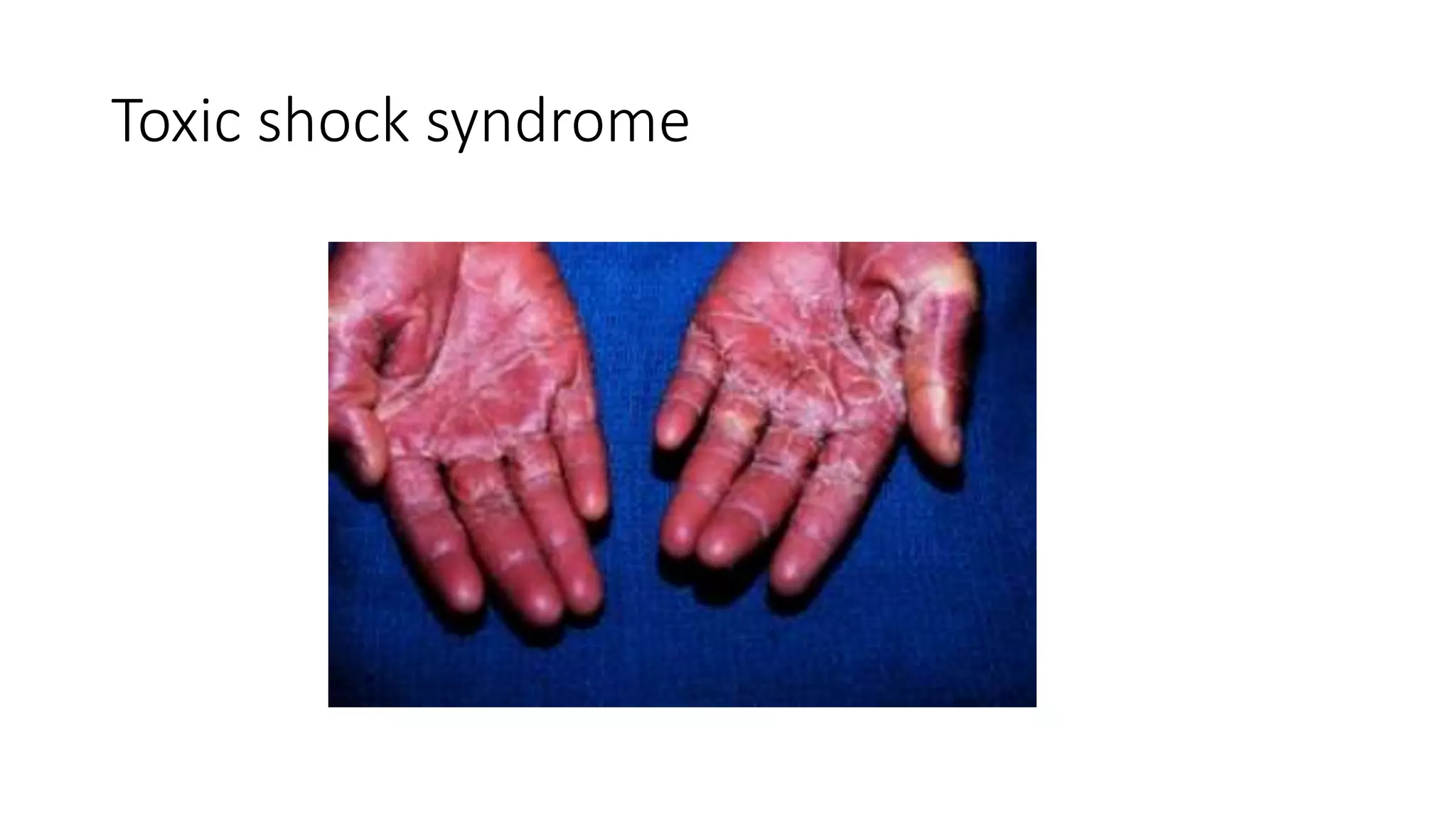 Toxic shock syndrome
 