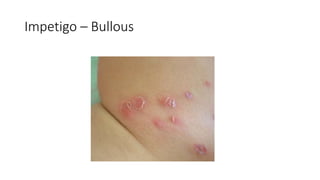 Impetigo – Bullous
 