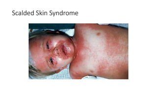 Scalded Skin Syndrome
 