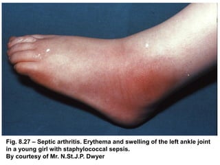 Fig. 8.27 – Septic arthritis. Erythema and swelling of the left ankle joint
in a young girl with staphylococcal sepsis.
By courtesy of Mr. N.St.J.P. Dwyer
 