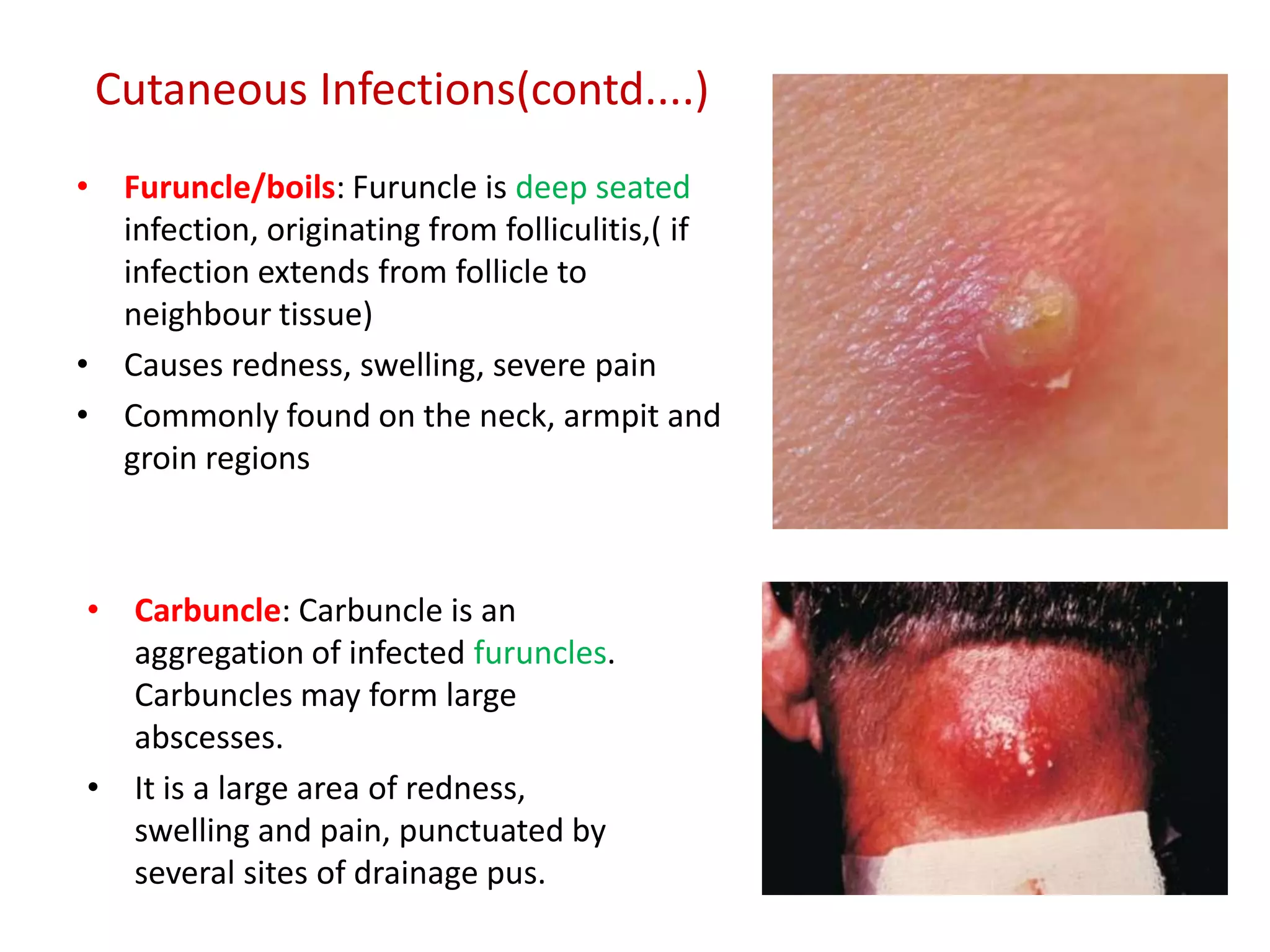 Cutaneous Infections(contd....)
• Furuncle/boils: Furuncle is deep seated
infection, originating from folliculitis,( if
infection extends from follicle to
neighbour tissue)
• Causes redness, swelling, severe pain
• Commonly found on the neck, armpit and
groin regions
• Carbuncle: Carbuncle is an
aggregation of infected furuncles.
Carbuncles may form large
abscesses.
• It is a large area of redness,
swelling and pain, punctuated by
several sites of drainage pus.
 
