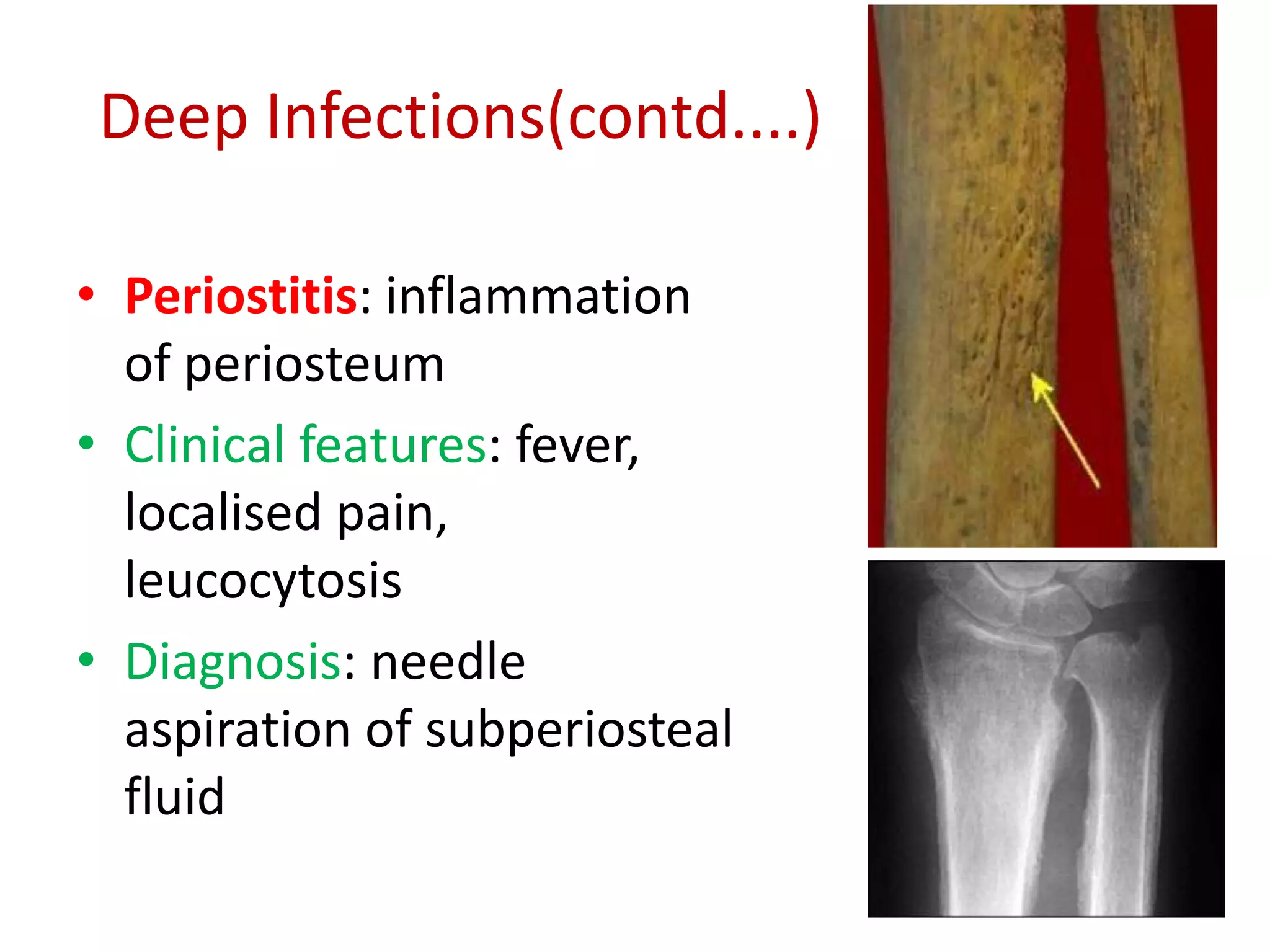 Deep Infections(contd....)
• Periostitis: inflammation
of periosteum
• Clinical features: fever,
localised pain,
leucocytosis
• Diagnosis: needle
aspiration of subperiosteal
fluid
 
