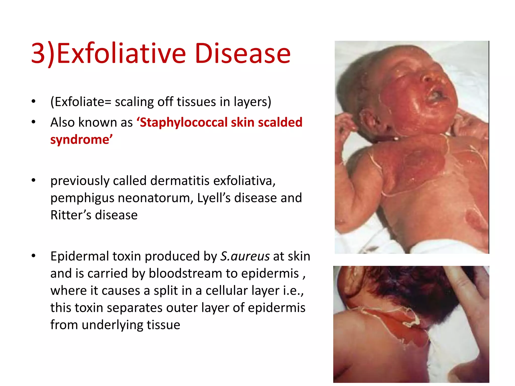 3)Exfoliative Disease
• (Exfoliate= scaling off tissues in layers)
• Also known as ‘Staphylococcal skin scalded
syndrome’
• previously called dermatitis exfoliativa,
pemphigus neonatorum, Lyell’s disease and
Ritter’s disease
• Epidermal toxin produced by S.aureus at skin
and is carried by bloodstream to epidermis ,
where it causes a split in a cellular layer i.e.,
this toxin separates outer layer of epidermis
from underlying tissue
 