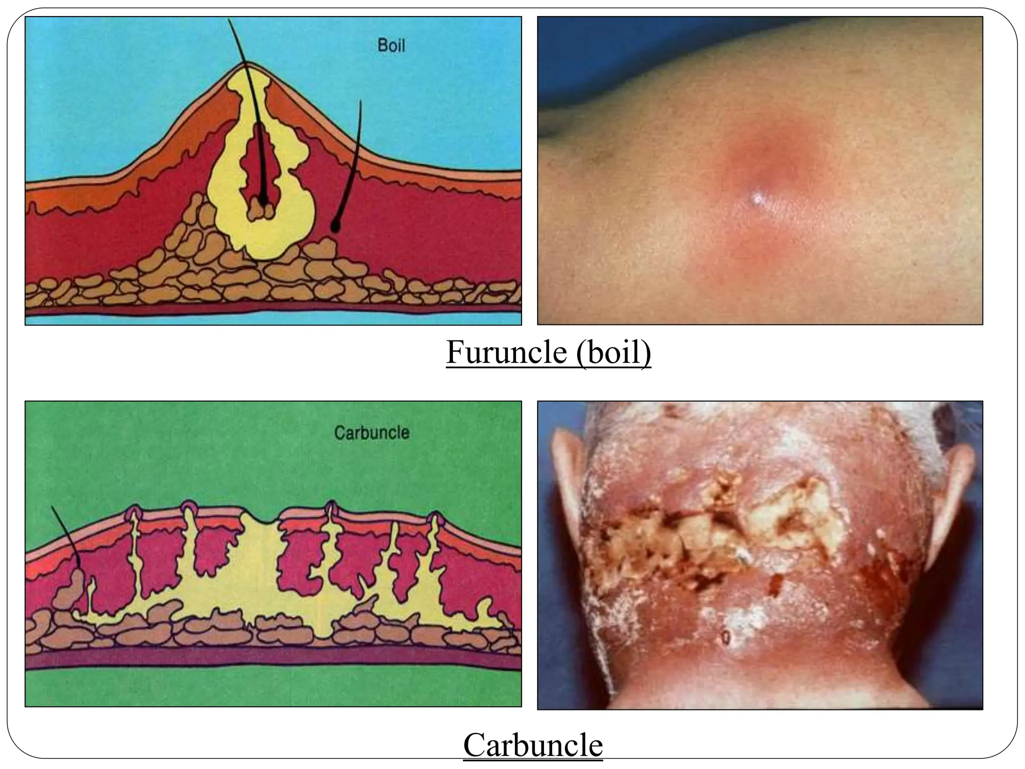 Furuncle (boil)
Carbuncle
 