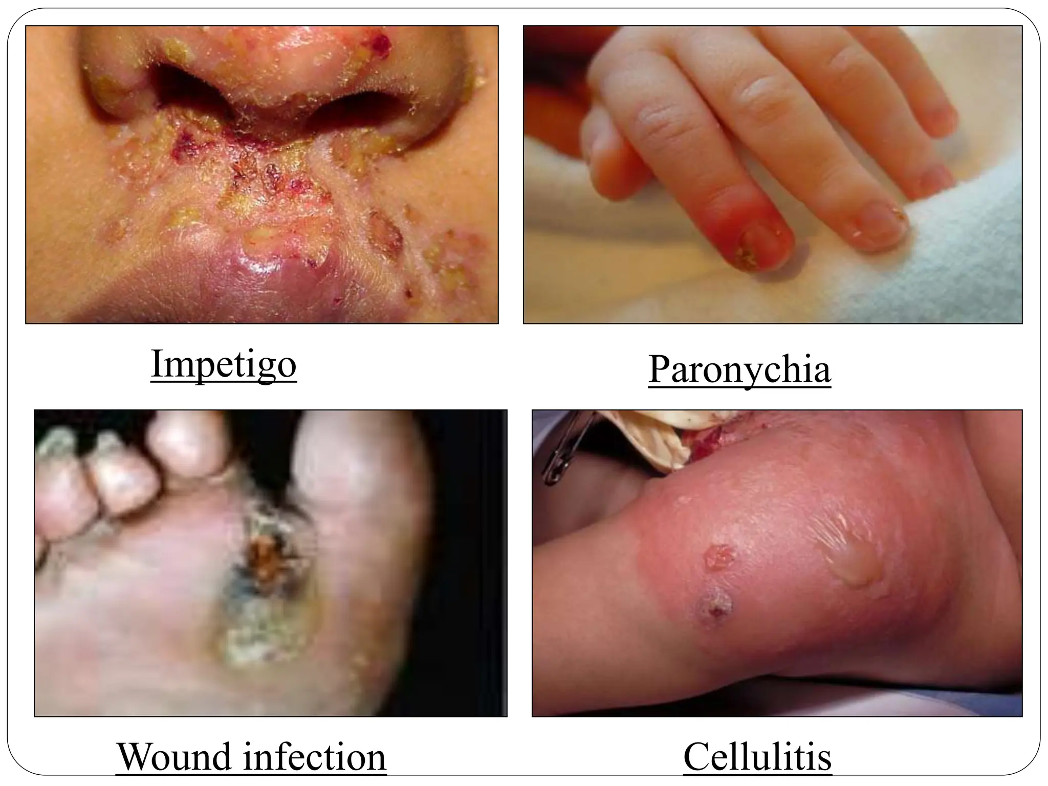 Impetigo Paronychia
Cellulitis
Wound infection
 
