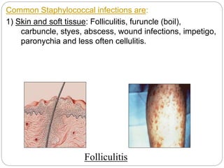 Common Staphylococcal infections are:
1) Skin and soft tissue: Folliculitis, furuncle (boil),
carbuncle, styes, abscess, wound infections, impetigo,
paronychia and less often cellulitis.
Folliculitis
Folliculitis
 