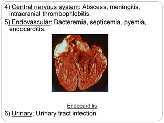 4) Central nervous system: Abscess, meningitis,
intracranial thrombophlebitis.
5) Endovascular: Bacteremia, septicemia, pyemia,
endocarditis.
Endocarditis
6) Urinary: Urinary tract infection.
 
