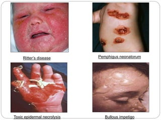 Toxic epidermal necrolysis
Ritter’s disease
Bullous impetigo
Pemphigus neonatorum
 