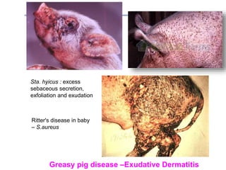 Greasy pig disease –Exudative Dermatitis
Sta. hyicus : excess
sebaceous secretion,
exfoliation and exudation
Ritter's disease in baby
– S.aureus
 