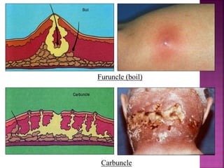 Furuncle (boil)
Carbuncle
 
