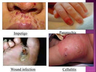 Impetigo Paronychia
CellulitisWound infection
 