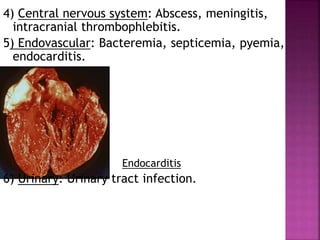 4) Central nervous system: Abscess, meningitis,
intracranial thrombophlebitis.
5) Endovascular: Bacteremia, septicemia, pyemia,
endocarditis.
Endocarditis
6) Urinary: Urinary tract infection.
 