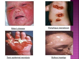 Toxic epidermal necrolysis
Ritter’s disease
Bullous impetigo
Pemphigus neonatorum
 