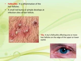 • Folliculitis: It is inflammation of the
hair follicles.
• A small red bump or pimple develops at
infection sites of hair follicle.
•Sty: A sty is folliculitis affecting one or more
hair follicles on the edge of the upper or lower
eyelid.
 