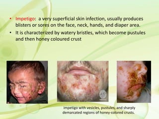 • Impetigo: a very superficial skin infection, usually produces
blisters or sores on the face, neck, hands, and diaper area.
• It is characterized by watery bristles, which become pustules
and then honey coloured crust
impetigo with vesicles, pustules, and sharply
demarcated regions of honey-colored crusts.
 