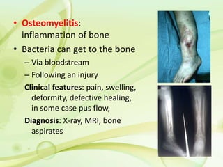 • Osteomyelitis:
inflammation of bone
• Bacteria can get to the bone
– Via bloodstream
– Following an injury
Clinical features: pain, swelling,
deformity, defective healing,
in some case pus flow,
Diagnosis: X-ray, MRI, bone
aspirates
 