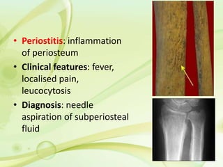 • Periostitis: inflammation
of periosteum
• Clinical features: fever,
localised pain,
leucocytosis
• Diagnosis: needle
aspiration of subperiosteal
fluid
 