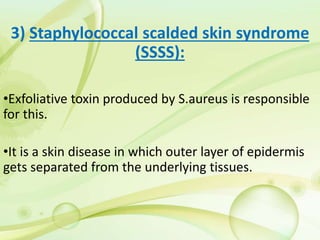 3) Staphylococcal scalded skin syndrome
(SSSS):
•Exfoliative toxin produced by S.aureus is responsible
for this.
•It is a skin disease in which outer layer of epidermis
gets separated from the underlying tissues.
 
