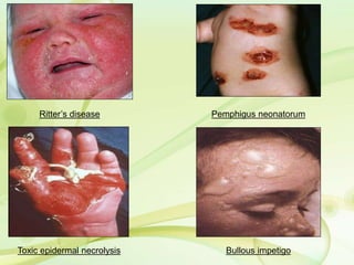 Ritter’s disease Pemphigus neonatorum
Toxic epidermal necrolysis Bullous impetigo
 