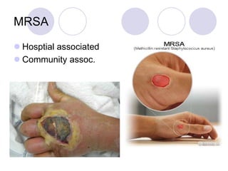 MRSA
 Hosptial associated
 Community assoc.
 