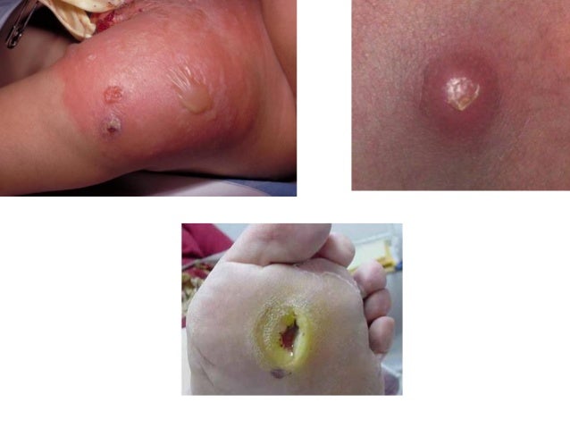 Staphylococcus