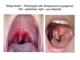 ”Strep throat” – Pharyngitis with Streptococcus pyogenes:
left – petechiae; right – pus deposits
 