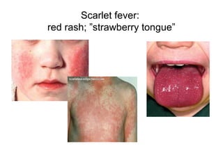 Scarlet fever:
red rash; ”strawberry tongue”
 