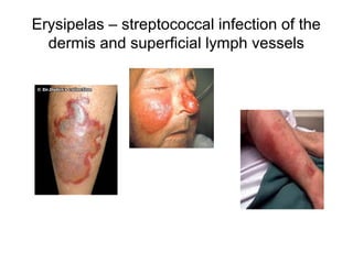 Erysipelas – streptococcal infection of the
dermis and superficial lymph vessels
 