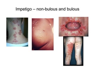 Impetigo – non-bulous and bulous
 