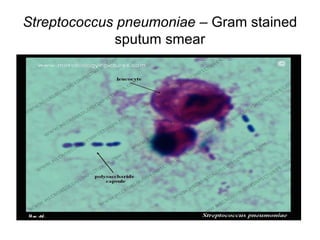 Streptococcus pneumoniae – Gram stained
sputum smear
 