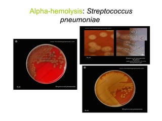 Alpha-hemolysis: Streptococcus
pneumoniae
 