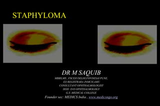 STAPHYLOMA VIRAL KERATITIS
DR M SAQUIB
MBBS,MS , FSCEH DELHI,FHVDESAI PUNE,
EX REGISTRARA JNMCH,AMU
CONSULTANT OPHTHALMOLOGIST
HOD D/O OPHTHALMOLOGY
G.S .MEDICAL COLLEGE
Founder sec: MEDICS India , www.medicsngo.org
 