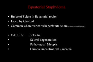 Equatorial Staphyloma
• Bulge of Sclera in Equatorial region
• Lined by Choroid
• Common where vortex vein perforate sclera (14mm behind limbus)
• CAUSES: Scleritis
• Scleral degeneration
• Pathological Myopia
• Chronic uncontrolled Glaucoma
 