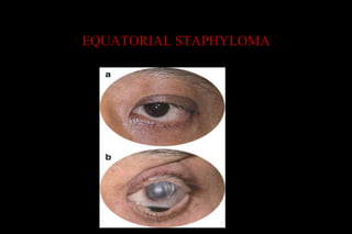EQUATORIAL STAPHYLOMA
 