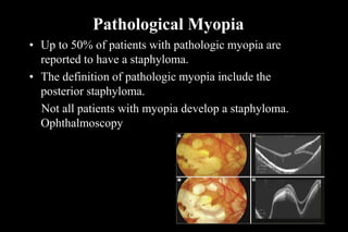 Pathological Myopia
• Up to 50% of patients with pathologic myopia are
reported to have a staphyloma.
• The definition of pathologic myopia include the
posterior staphyloma.
Not all patients with myopia develop a staphyloma.
Ophthalmoscopy
 