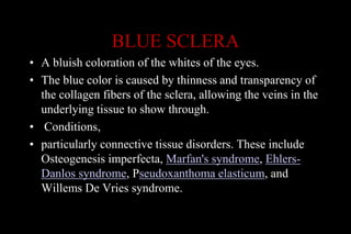 BLUE SCLERA
• A bluish coloration of the whites of the eyes.
• The blue color is caused by thinness and transparency of
the collagen fibers of the sclera, allowing the veins in the
underlying tissue to show through.
• Conditions,
• particularly connective tissue disorders. These include
Osteogenesis imperfecta, Marfan's syndrome, Ehlers-
Danlos syndrome, Pseudoxanthoma elasticum, and
Willems De Vries syndrome.
 