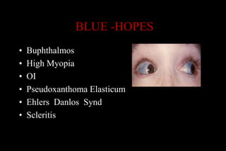 BLUE -HOPES
• Buphthalmos
• High Myopia
• OI
• Pseudoxanthoma Elasticum
• Ehlers Danlos Synd
• Scleritis
 