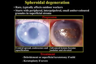 Spheroidal degeneration
Treatment
Central spread, coalescence and
opacification
Advanced lesions become
nodular and elevated
• Rare, typically affects outdoor workers
• Starts with peripheral, interpalpebral, small amber-coloured
granules in superficial stroma
• Debridement or superficial keratotomy if mild
• Keratoplasty if severe
Progression
 