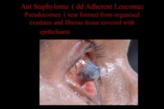 Ant Staphyloma ( dd Adherent Leucoma)
Pseudocornea ( scar formed from organised
exudates and fibrous tissue covered with
epithelium)ughing of cornea
 