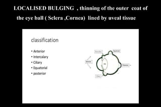 LOCALISED BULGING , thinning of the outer, coat of
the eye ball ( Sclera ,Cornea) lined by uveal tissue ..f
the eye
 