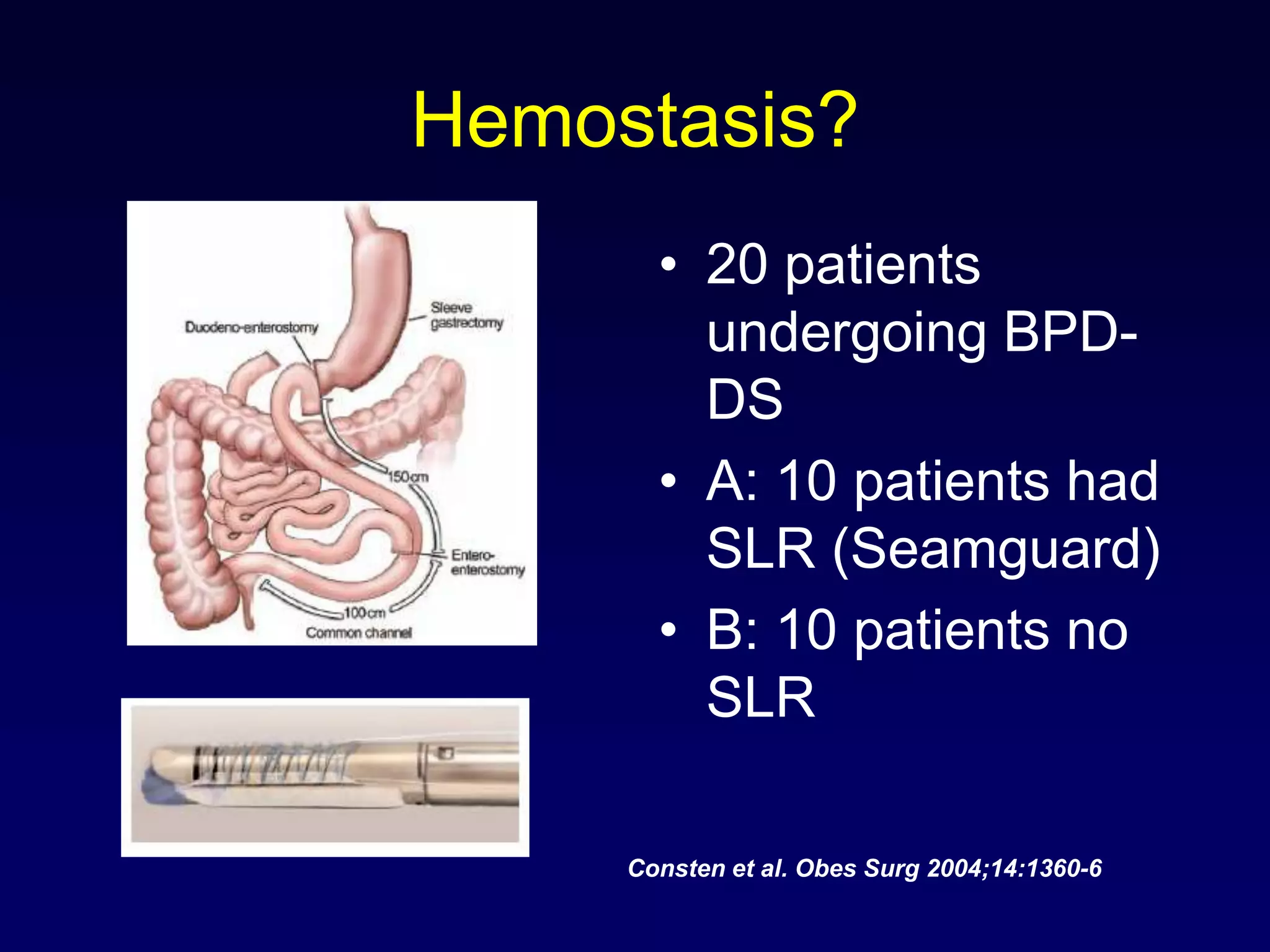 Hemostasis?20 patients undergoing BPD-DSA: 10 patients had SLR (Seamguard)B: 10 patients no SLRConsten et al. ObesSurg 2004;14:1360-6