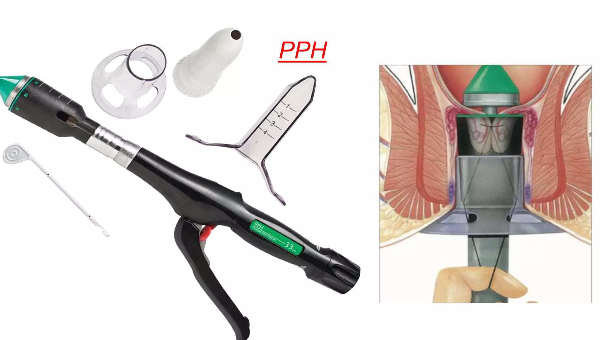 Staplers in Surgery | PPTX