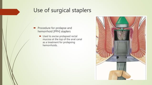 Use of Staplers in surgery | PPTX | Surgery | Medical Health