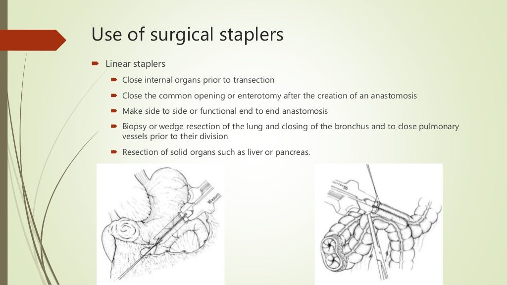 Use of Staplers in surgery