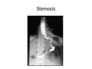 Stapling devices in surgery | PPTX
