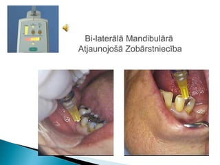Bi-laterālā Mandibulārā
Atjaunojošā Zobārstniecība
 