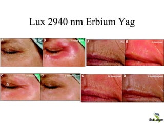 Lux 2940 nm Erbium Yag
 