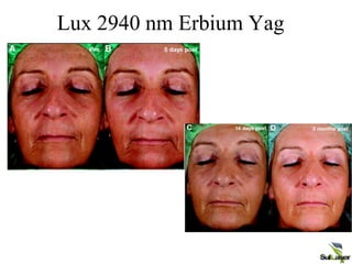 Lux 2940 nm Erbium Yag
 